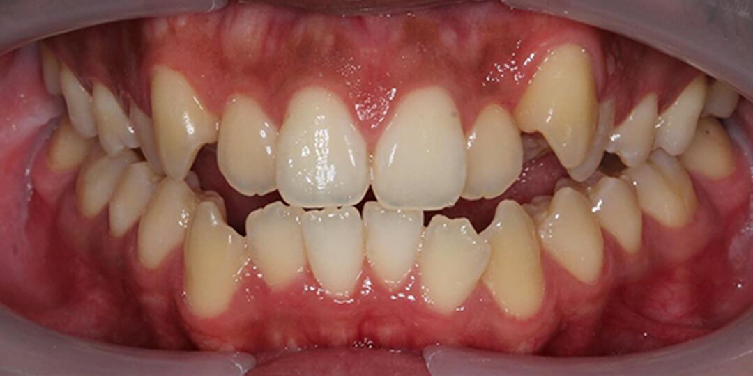 single tooth replacement cost
