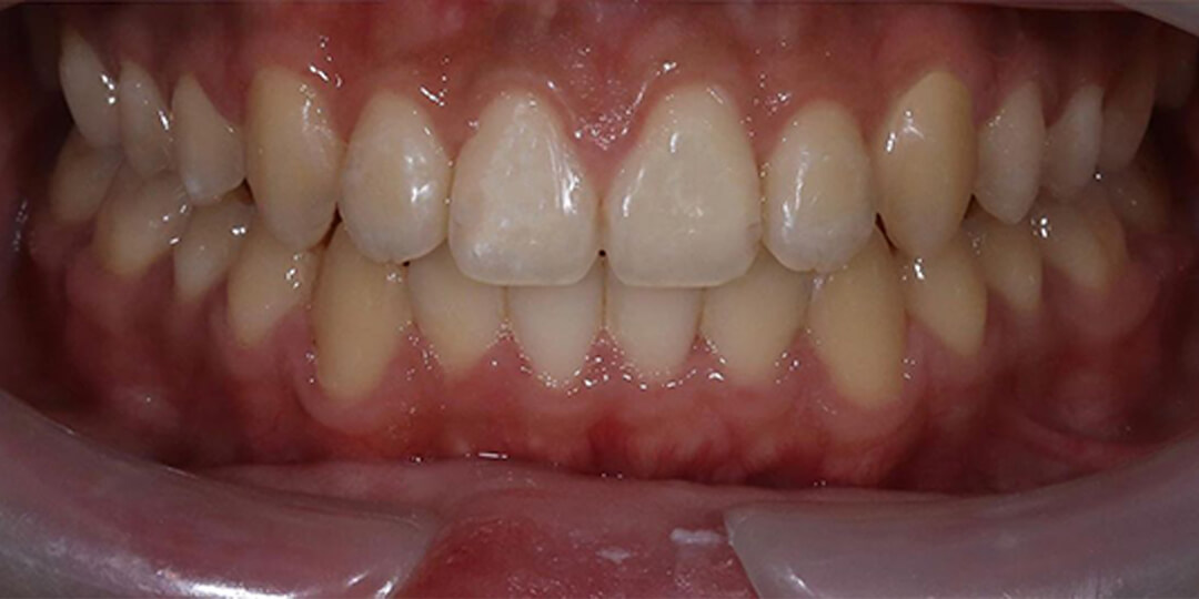 Single tooth implants