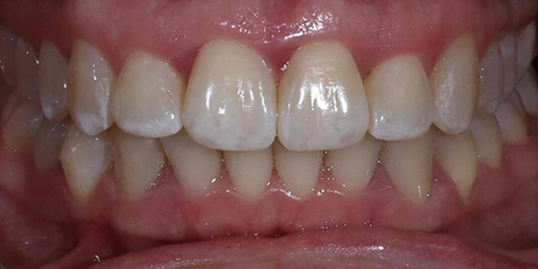 implant supported bridge cost