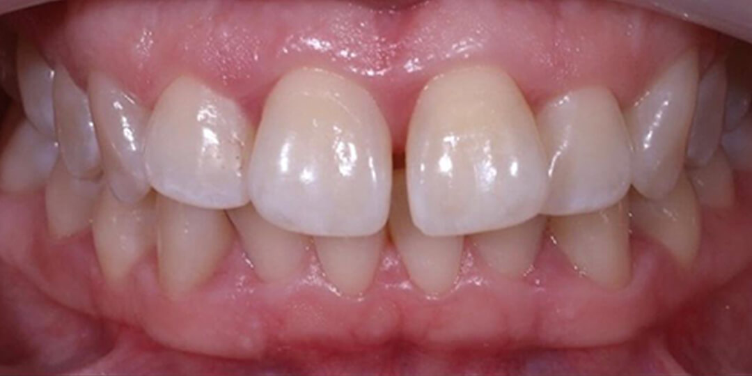 implant supported bridge front teeth