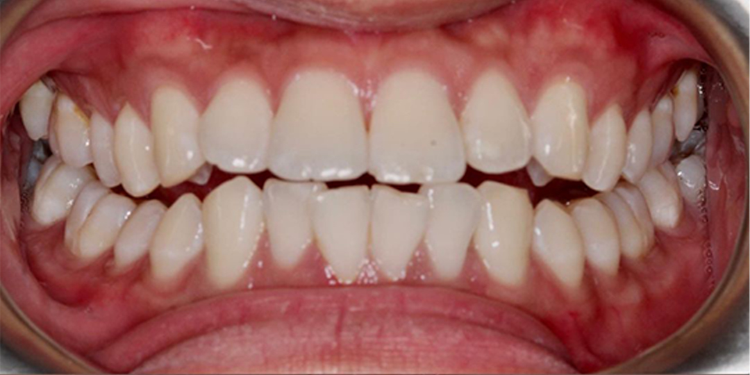 dental smile makeover