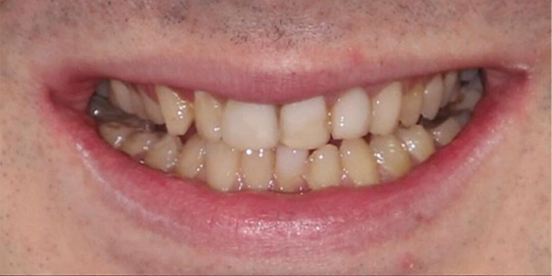 porcelain dental crown