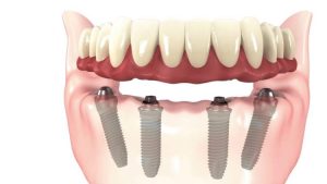 All-on-4 Dental Implants