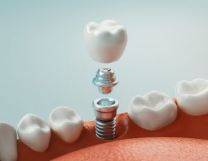 Dental Implant Procedure Auckland