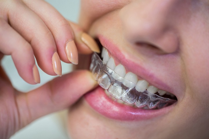 Cosmetic makeover (Invisalign braces)