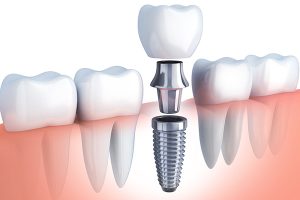 Dental Implants in Auckland
