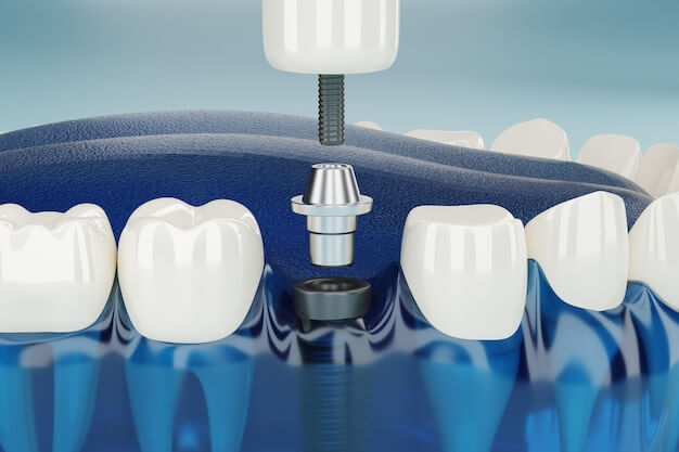 Implant-Supported Bridge