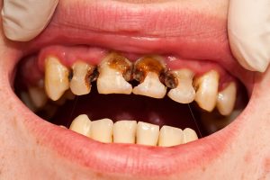 Cavities