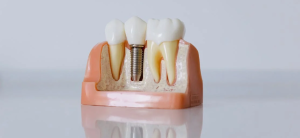 Dental Implants