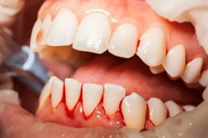 Gum Disease