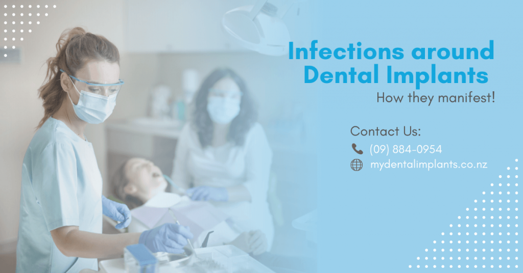 affordable dental implants Auckland