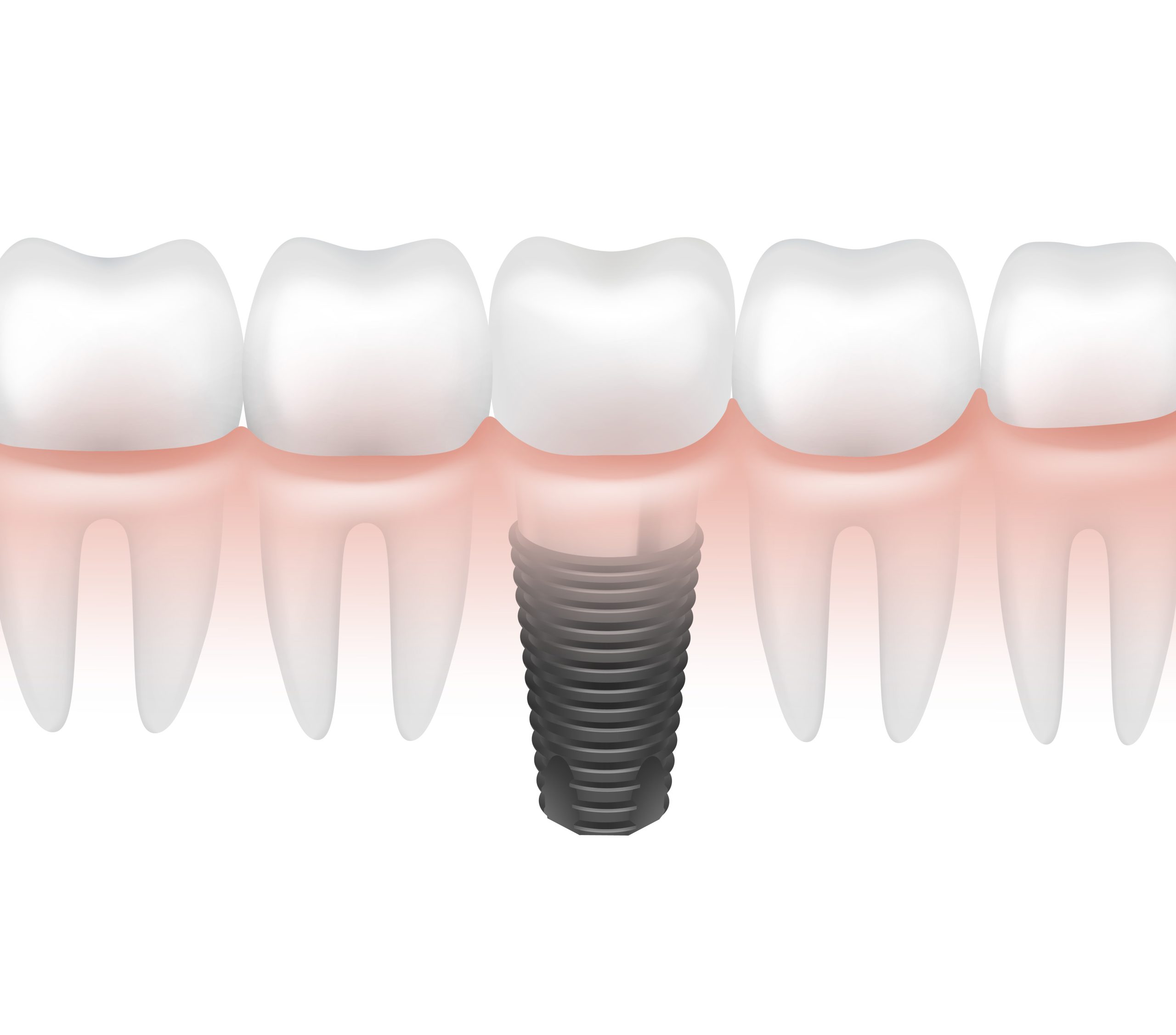 Single-Tooth Dental Implant