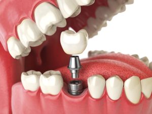 Single-Tooth Dental Implant