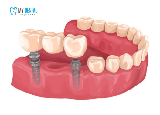 Implant-Supported Bridge